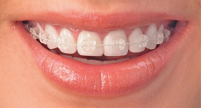 Brackets de porcelana