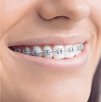 Brackets metálicos