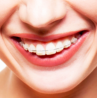 Brackets de porcelana